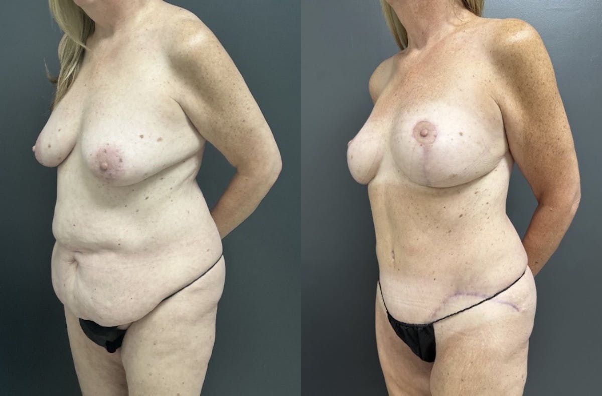 Abdominoplasty (Tummy Tuck) Before & After Gallery - Patient 344180 - Image 2