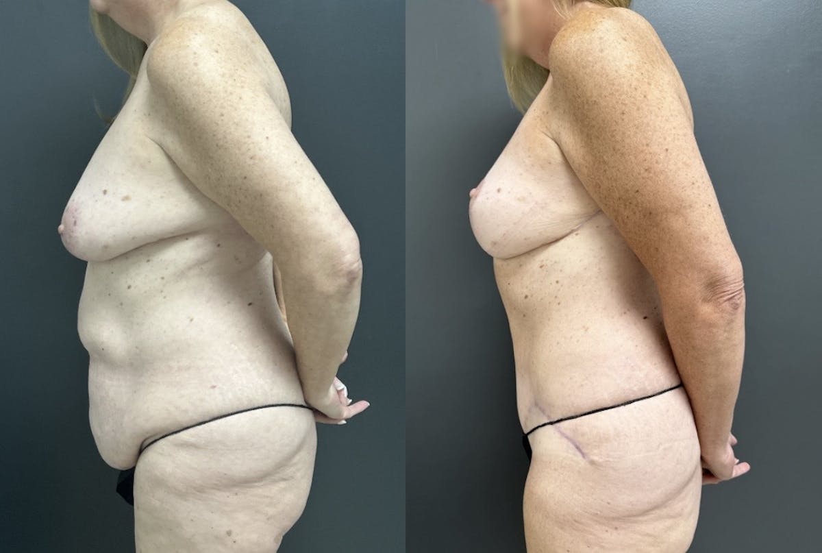 Abdominoplasty (Tummy Tuck) Before & After Gallery - Patient 344180 - Image 3