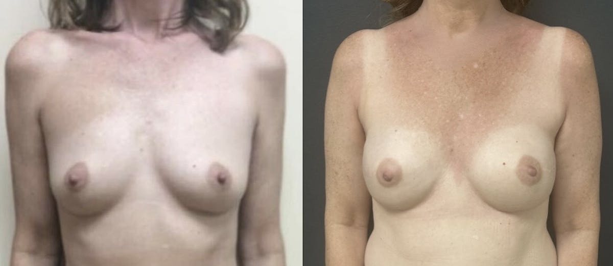 Breast Reconstruction Before & After Gallery - Patient 405554 - Image 1