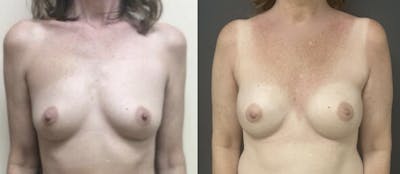 Breast Reconstruction Before & After Gallery - Patient 405554 - Image 1