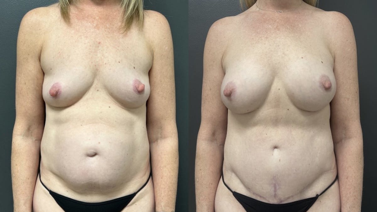 Abdominoplasty (Tummy Tuck) Before & After Gallery - Patient 427836 - Image 1