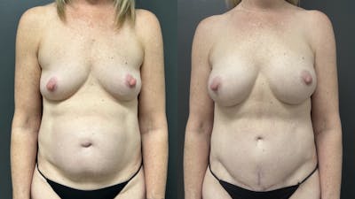 Abdominoplasty (Tummy Tuck) Before & After Gallery - Patient 427836 - Image 1