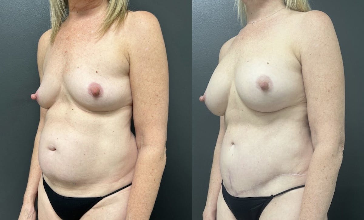 Abdominoplasty (Tummy Tuck) Before & After Gallery - Patient 427836 - Image 2