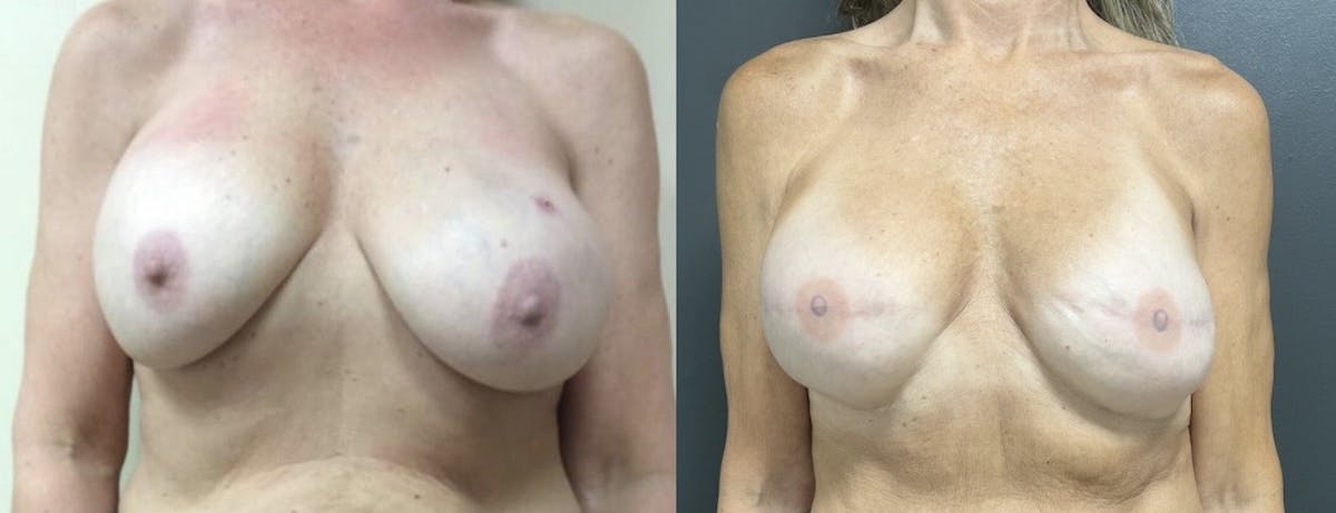 Breast Reconstruction Before & After Gallery - Patient 233382 - Image 1