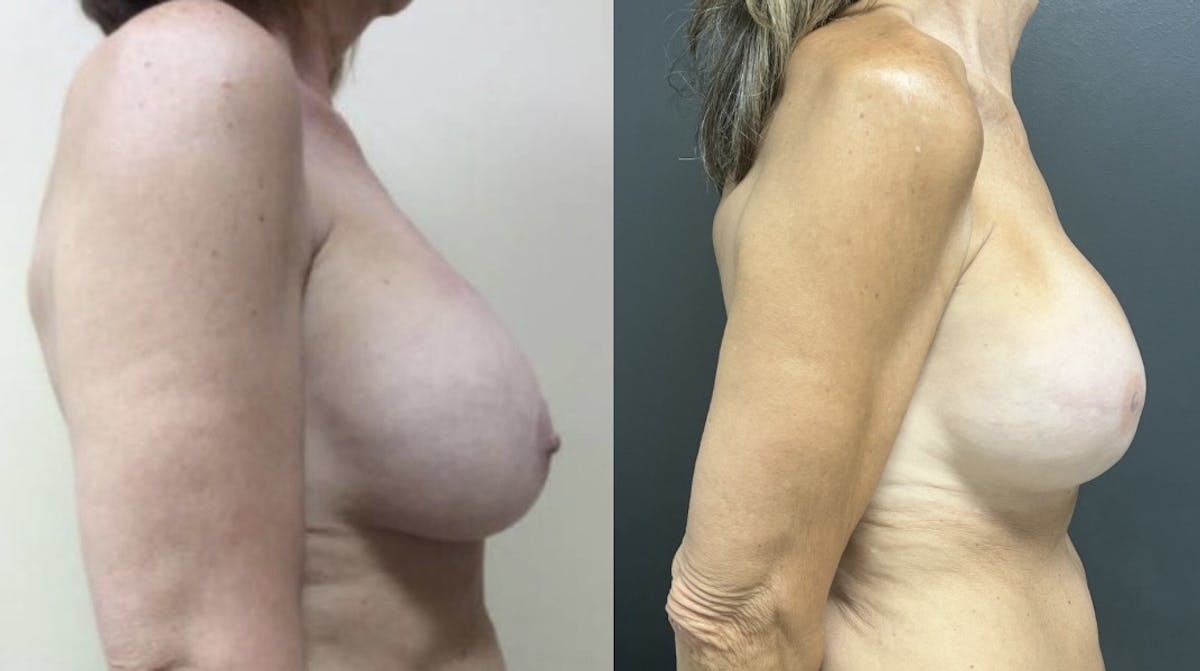 Breast Reconstruction Before & After Gallery - Patient 233382 - Image 2