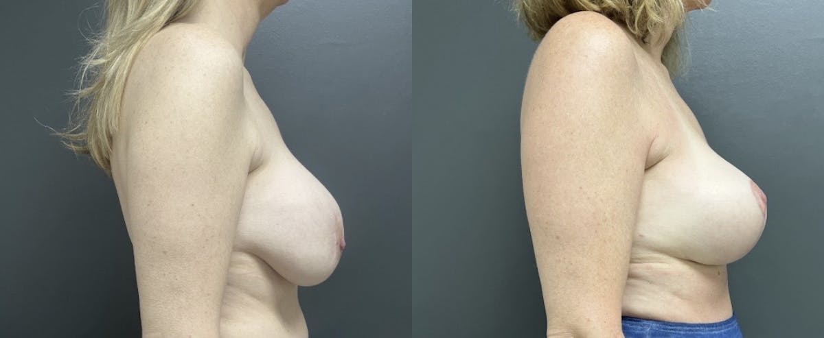 Breast Augmentation with Lift Before & After Gallery - Patient 152994 - Image 3
