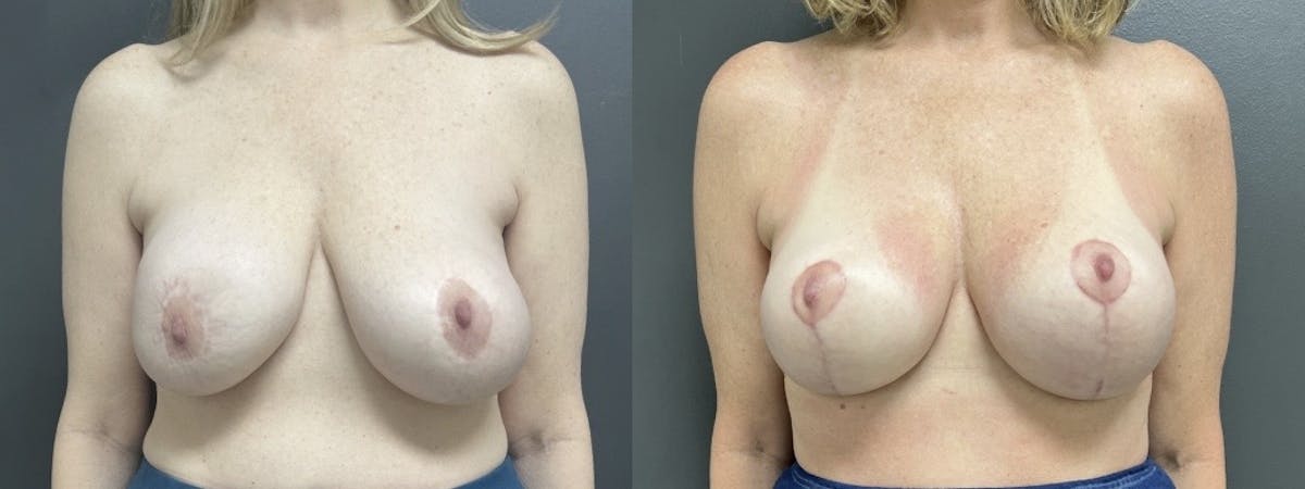 Breast Augmentation with Lift Before & After Gallery - Patient 152994 - Image 1