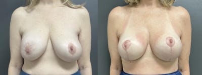 Breast Augmentation with Lift Before & After Gallery - Patient 152994 - Image 1