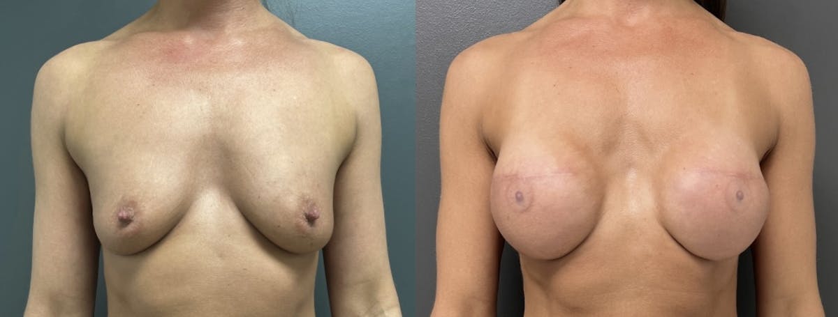 Breast Reconstruction Before & After Gallery - Patient 250782 - Image 1