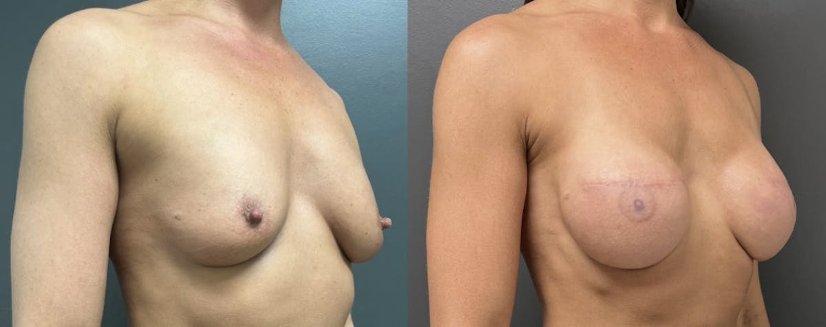 Breast Reconstruction Before & After Gallery - Patient 250782 - Image 2