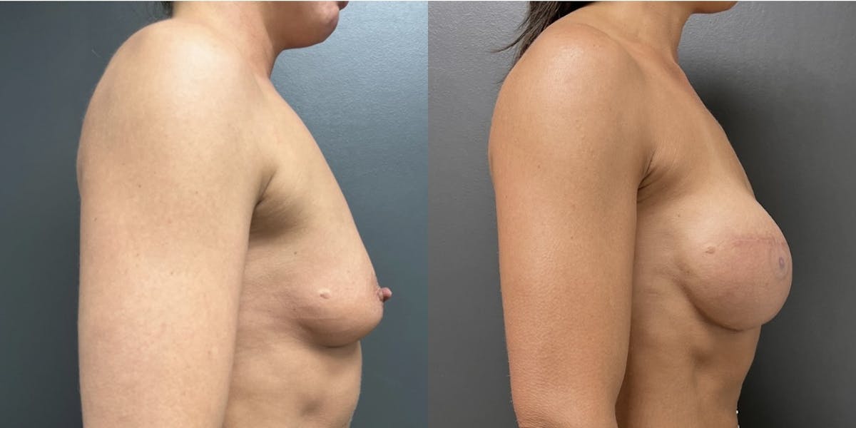 Breast Reconstruction Before & After Gallery - Patient 250782 - Image 3