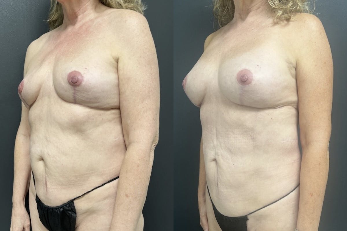 Liposuction Before & After Gallery - Patient 124540 - Image 2