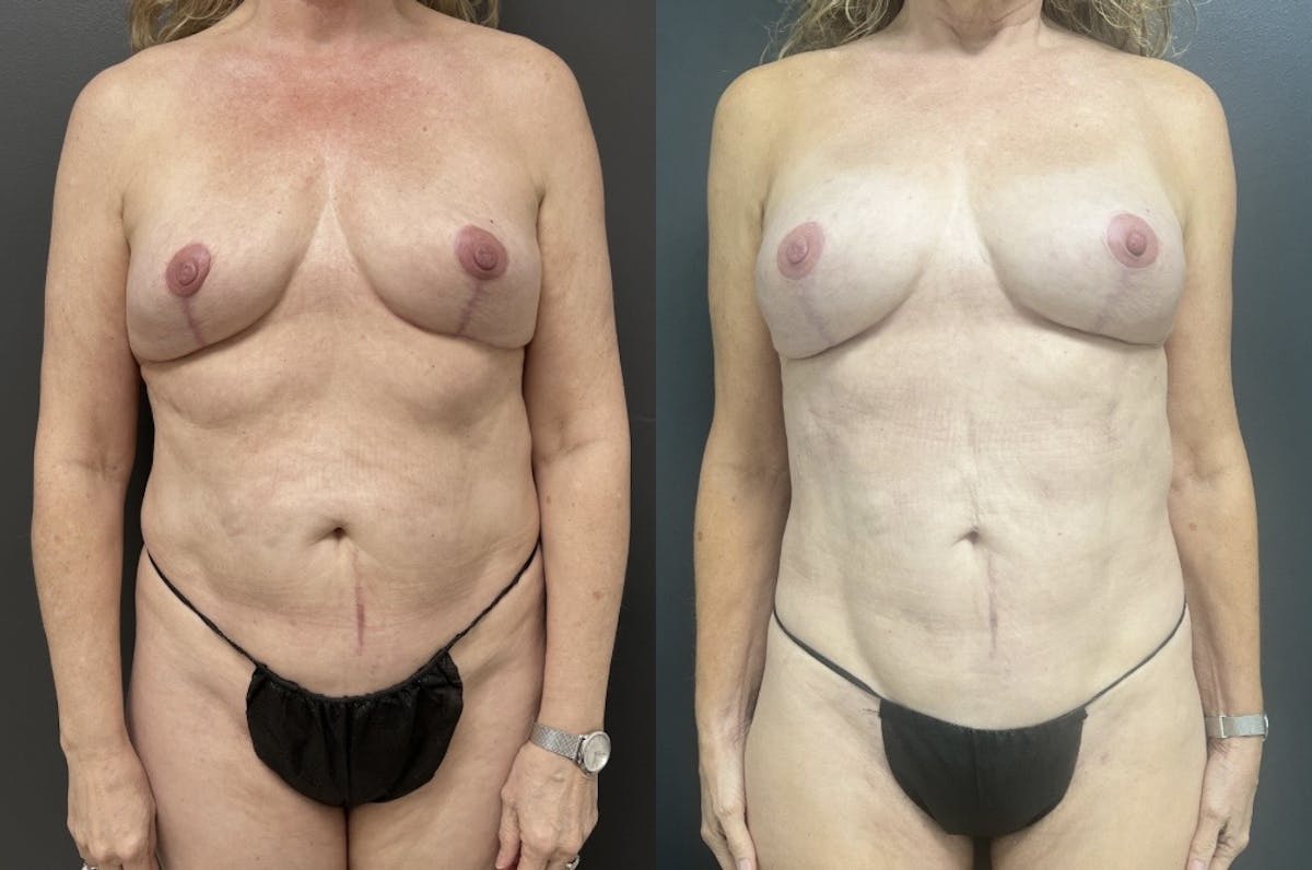 Liposuction Before & After Gallery - Patient 124540 - Image 1