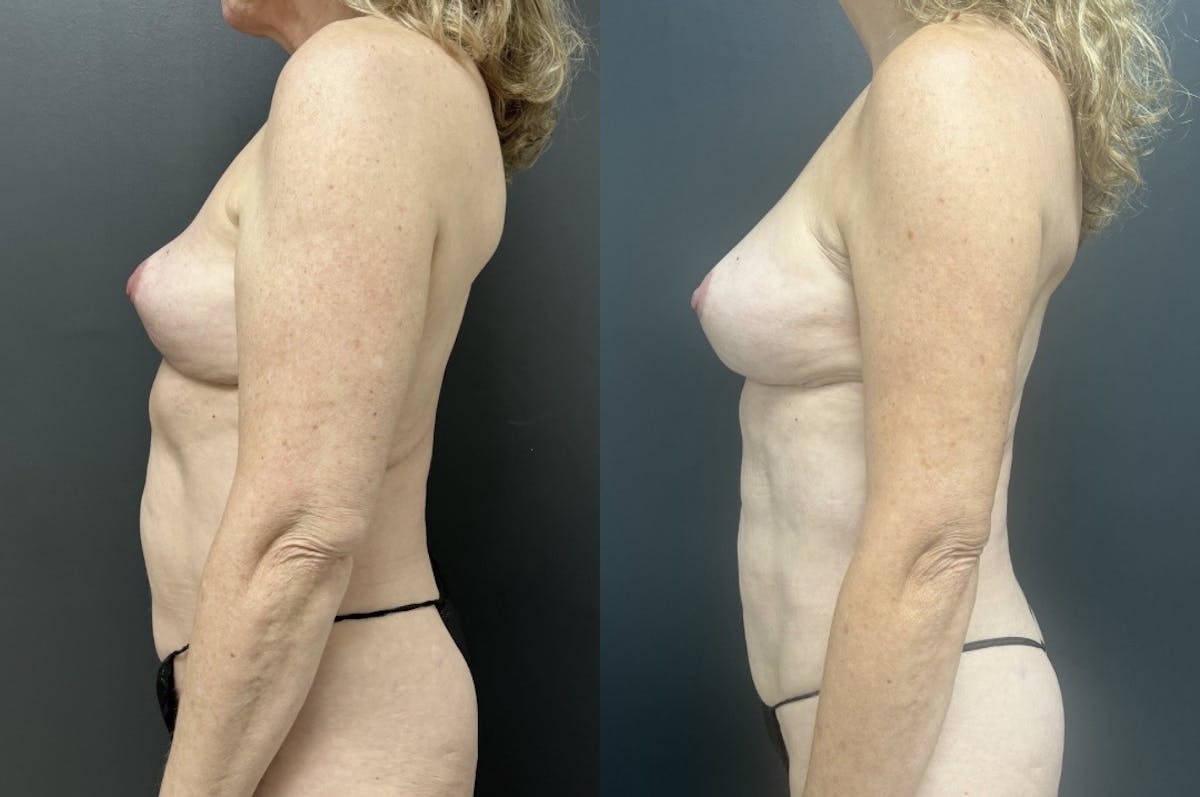Liposuction Before & After Gallery - Patient 124540 - Image 3