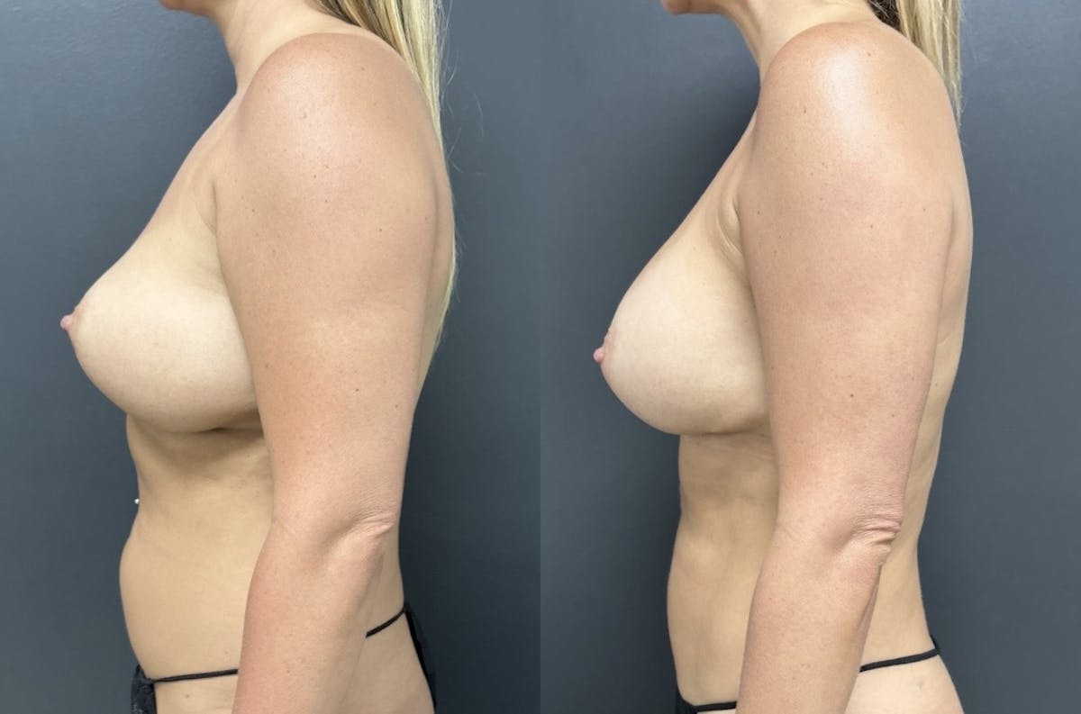 Abdomen Before & After Gallery - Patient 162210 - Image 2