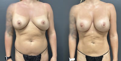 Liposuction Before & After Gallery - Patient 832990 - Image 1