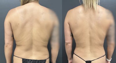 Liposuction Before & After Gallery - Patient 252593 - Image 1