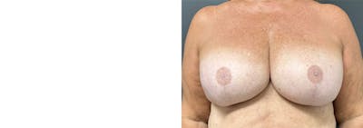 Breast Reconstruction Before & After Gallery - Patient 350092 - Image 1