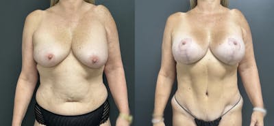 Abdominoplasty (Tummy Tuck) Before & After Gallery - Patient 599761 - Image 1