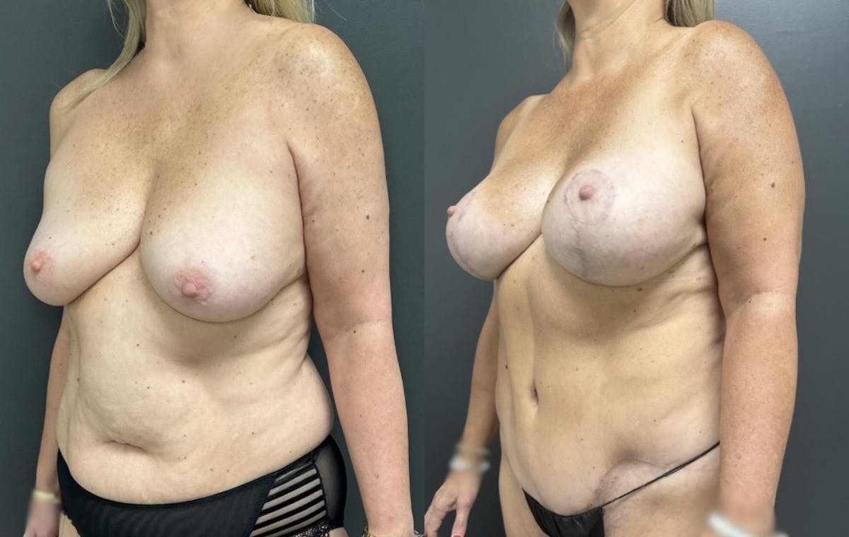 Abdominoplasty (Tummy Tuck) Before & After Gallery - Patient 599761 - Image 2