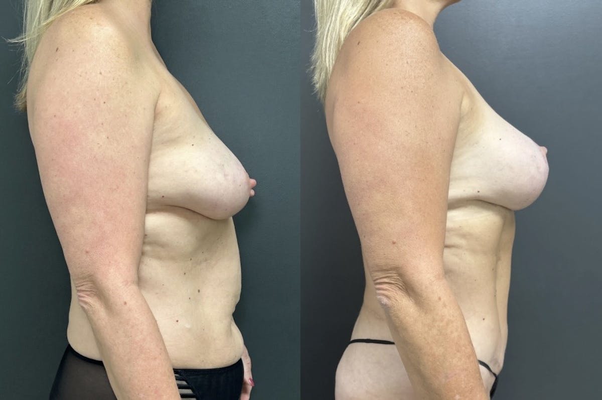 Abdominoplasty (Tummy Tuck) Before & After Gallery - Patient 599761 - Image 3
