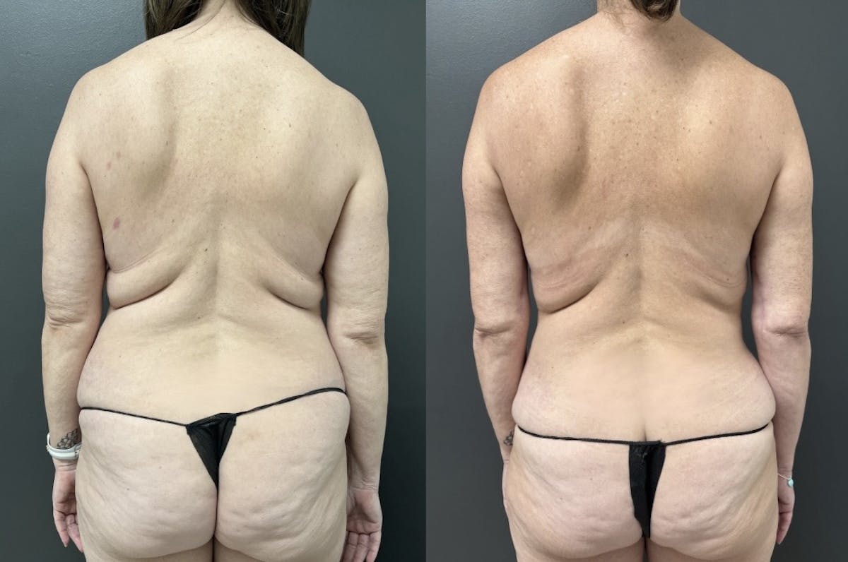 Flanks Before & After Gallery - Patient 412872 - Image 1