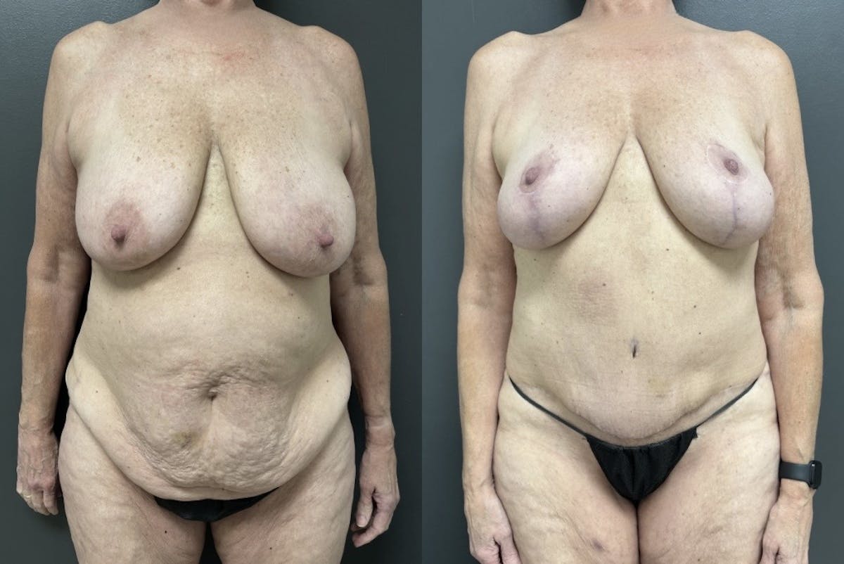 Abdominoplasty (Tummy Tuck) Before & After Gallery - Patient 275322 - Image 1