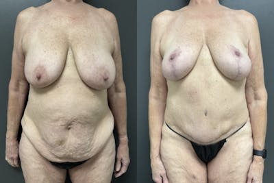 Abdominoplasty (Tummy Tuck) Before & After Gallery - Patient 275322 - Image 1