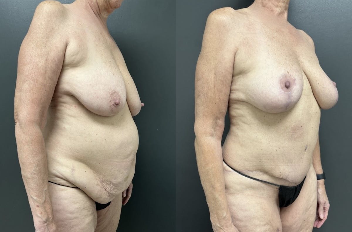 Abdominoplasty (Tummy Tuck) Before & After Gallery - Patient 275322 - Image 2