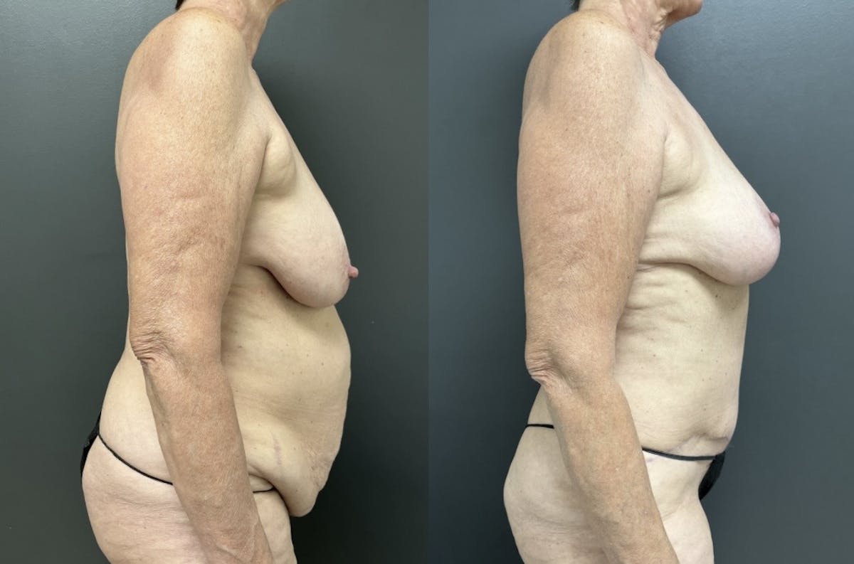 Abdominoplasty (Tummy Tuck) Before & After Gallery - Patient 275322 - Image 3