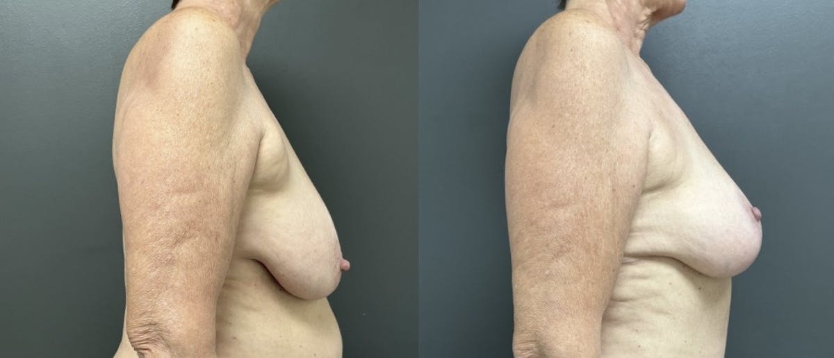 Mastopexy (Breast Lift) Before & After Gallery - Patient 384662 - Image 3
