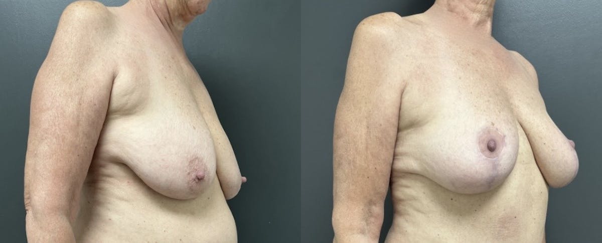 Mastopexy (Breast Lift) Before & After Gallery - Patient 384662 - Image 2