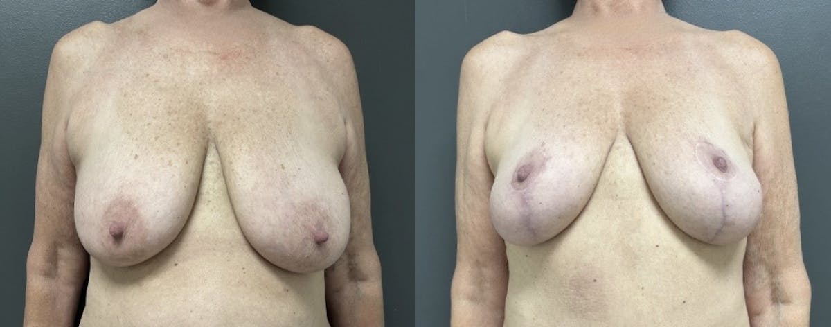 Mastopexy (Breast Lift) Before & After Gallery - Patient 384662 - Image 1
