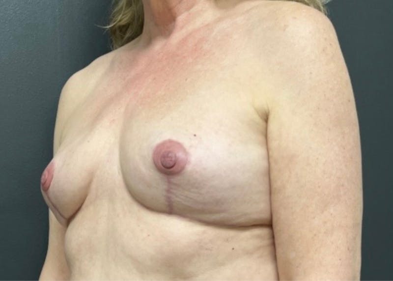 Breast Fat Grafting Before & After Gallery - Patient 129556 - Image 3