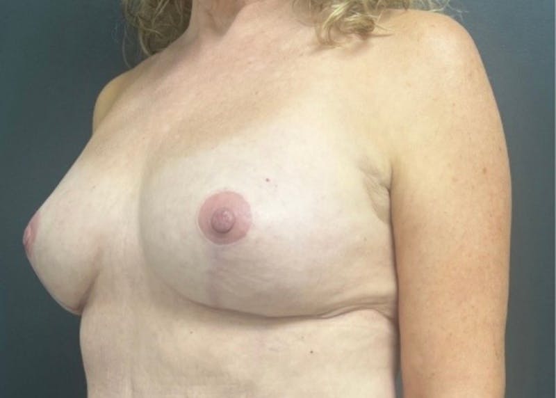 Breast Fat Grafting Before & After Gallery - Patient 129556 - Image 4
