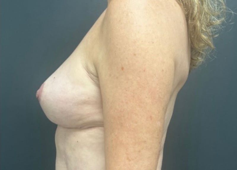 Breast Fat Grafting Before & After Gallery - Patient 129556 - Image 6
