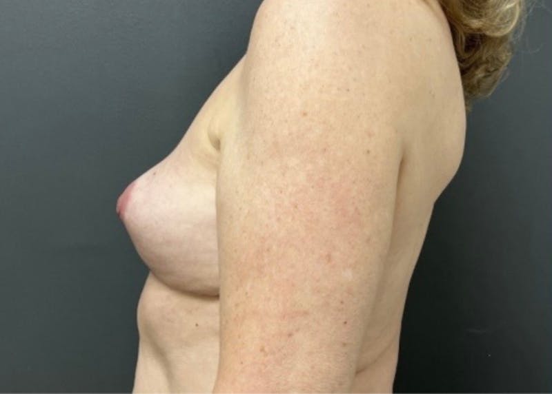 Breast Fat Grafting Before & After Gallery - Patient 129556 - Image 5