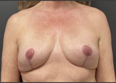 Breast Fat Grafting Before & After Gallery - Patient 129556 - Image 1