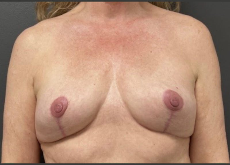 Breast Fat Grafting Before & After Gallery - Patient 129556 - Image 1
