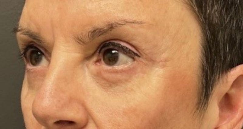 Blepharoplasty Before & After Gallery - Patient 102230 - Image 2