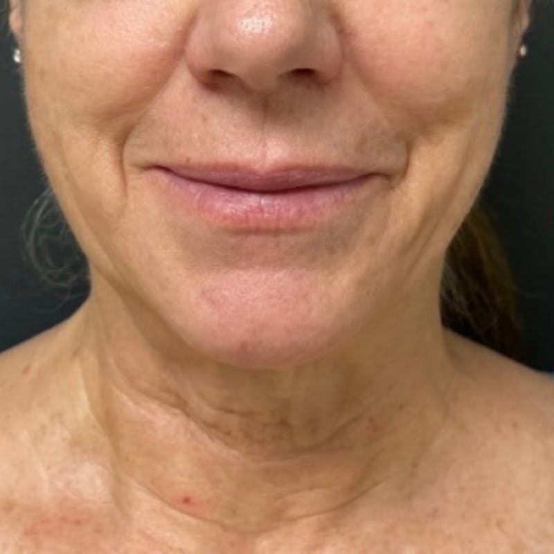 Facelift Before & After Gallery - Patient 176503 - Image 1