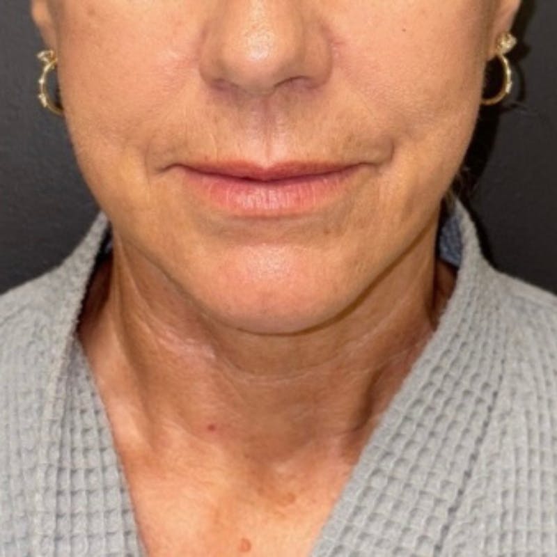 Facelift Before & After Gallery - Patient 176503 - Image 2