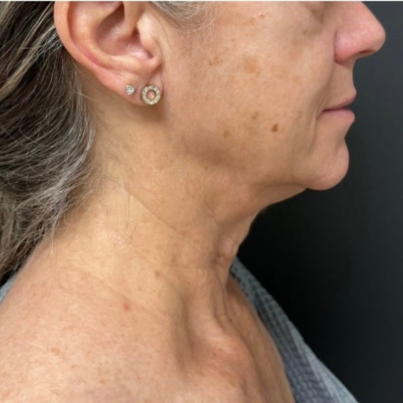 Facelift Before & After Gallery - Patient 176503 - Image 5