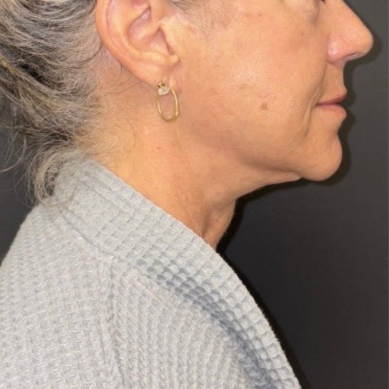 Facelift Before & After Gallery - Patient 176503 - Image 6