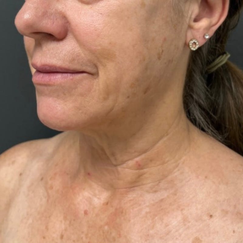 Facelift Before & After Gallery - Patient 176503 - Image 3