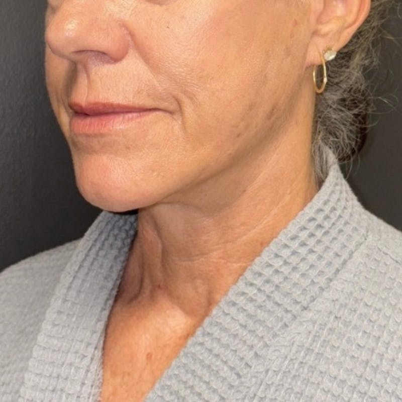 Facelift Before & After Gallery - Patient 176503 - Image 4