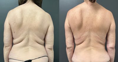 Liposuction Before & After Gallery - Patient 196625 - Image 1