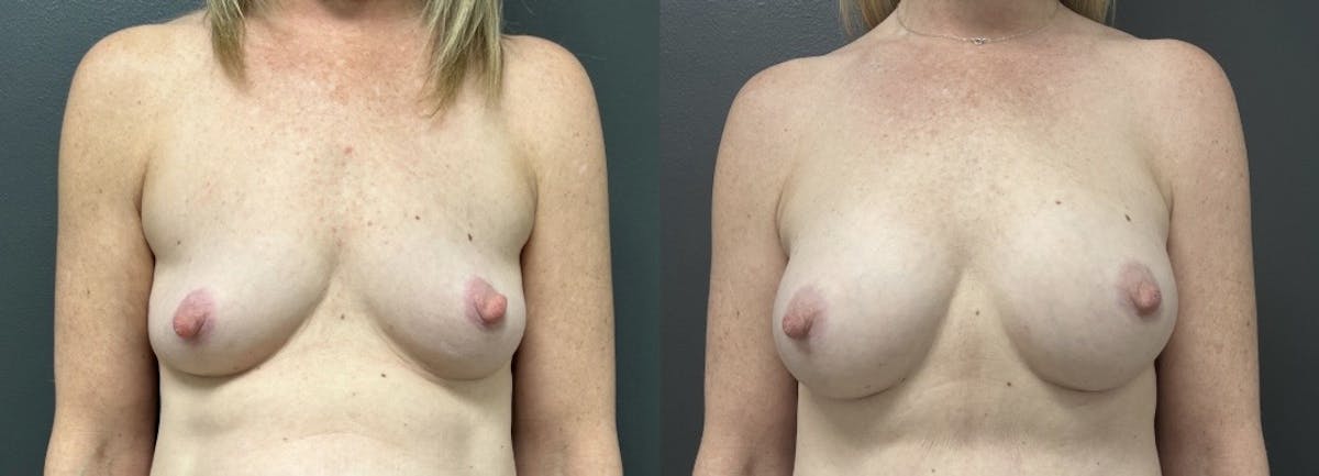Breast Augmentation Before & After Gallery - Patient 419880 - Image 1