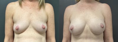 Breast Augmentation Before & After Gallery - Patient 419880 - Image 1
