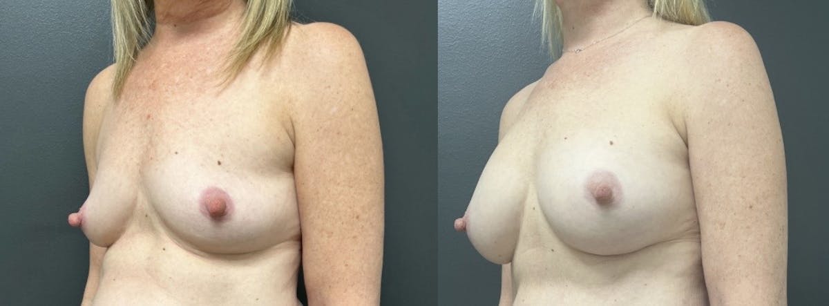 Breast Augmentation Before & After Gallery - Patient 419880 - Image 2
